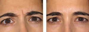 botox-4-300x109