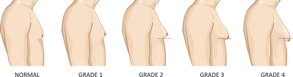 Diagram illustrating gynecomastia, normal through grade four